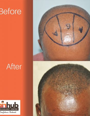 Hairhub The Trichology Centre – Hair Transplant In Kenya