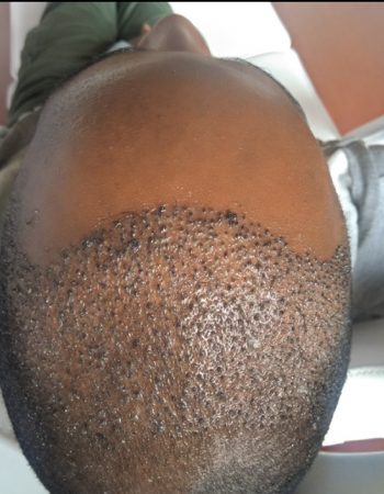 Nairobi Hair Restoration And Aesthetic Clinic