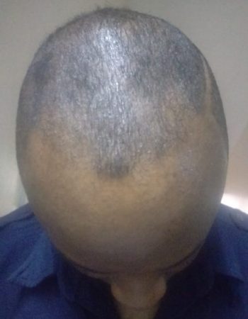 Nairobi Hair Restoration And Aesthetic Clinic