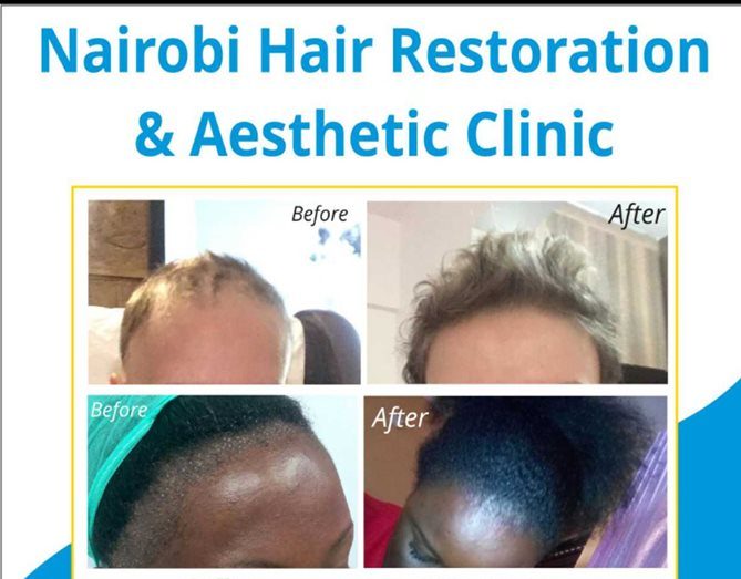 Nairobi Hair Restoration Clinic